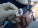 Allograft Meniscus Transplantation using Bridge in Slot Technique