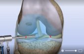 Articular Cartilage Problems – Removal of Damaged Cartilage