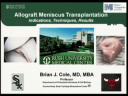 Meniscus Allograft Transplantation: Indications, Techniques, Results