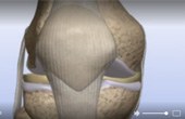 Patella Pain – Removal of Damaged Cartilage