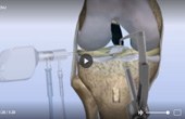 Torn ACL – Anatomic Footprint Reconstruction
