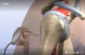 Trimming of Torn Labrum