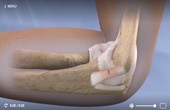 Ulnar Collateral Ligament Reconstruction-Tommy John Surgery